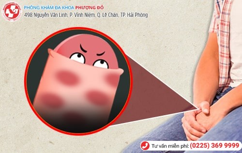 Bác sĩ chuyên khoa giải thích dấu hiệu dương vật nổi mẩn đỏ