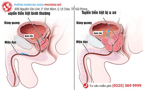 Ăn không ngon – ngủ không yên vì u xơ tuyến tiền liệt