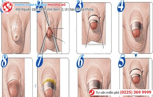 “Ái ân” trở lại sau khi cắt bao quy đầu