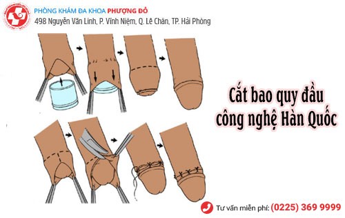 Cách mở bao quy đầu cho nam giới