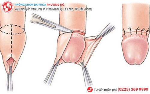 Hơn 96% cánh mày râu hết lo lắng dài bao quy đầu nhờ phương pháp này