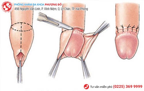 phẫu thuật bao quy đầu