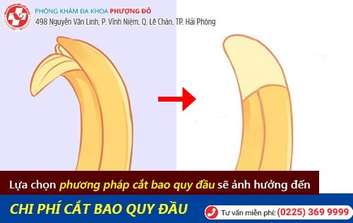 Chi phí cắt bao quy đầu không đau, không để sẹo