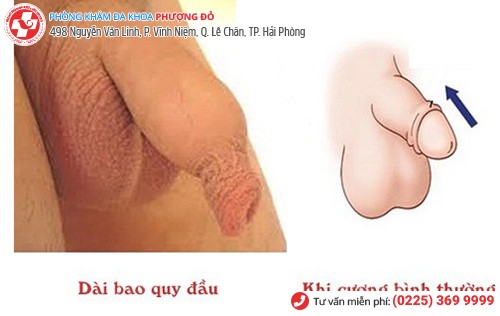 Dài bao quy đầu có nên cắt không?