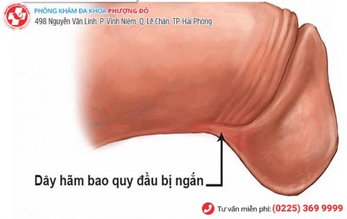 Dương vật ngắn