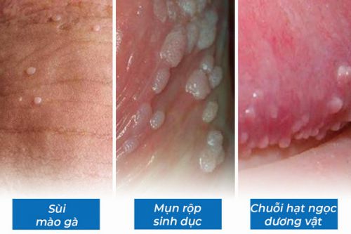 Dương vật nổi mụn trắng: Nguyên nhân và cách chữa trị hiệu quả