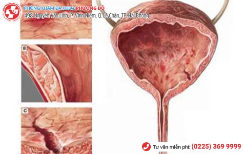 Chữa viêm bàng quang có đơn giản không?