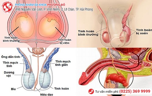 Nam giới bị đau tinh hoàn, lành hay dữ?