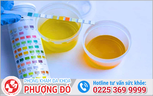 Nước tiểu màu vàng