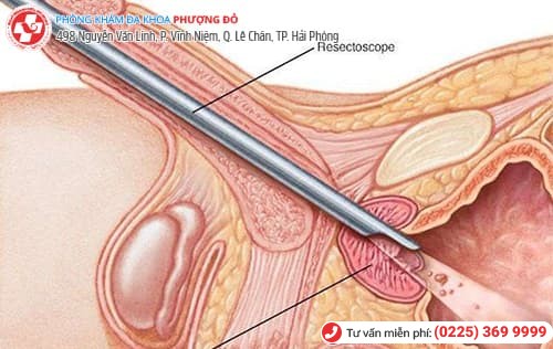 Điều trị sỏi tuyến tiền liệt có khó không?