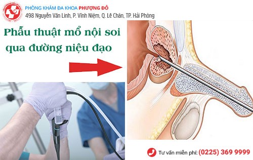 Phẫu thuật phì đại tuyến tiền liệt với các trường hợp bệnh nặng