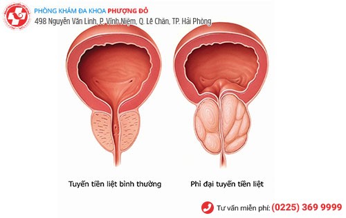 Phì đại tuyến tiền liệt