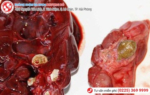 Trót “chơi bời” bên ngoài, nhận “trái đắng” vì viêm đường tiết niệu