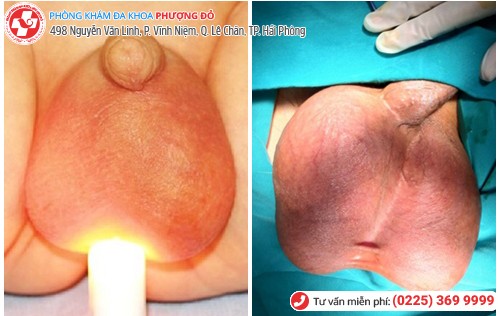 Sưng tinh hoàn - dấu hiệu cảnh báo bệnh nguy hiểm