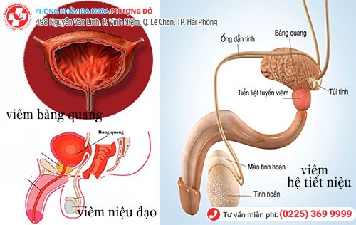  Đi tiểu buốt ở nam giới - Dấu hiệu của nhiều bệnh lý nguy hiểm