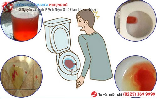 Tiểu ra máu do mắc bệnh viêm bàng quang