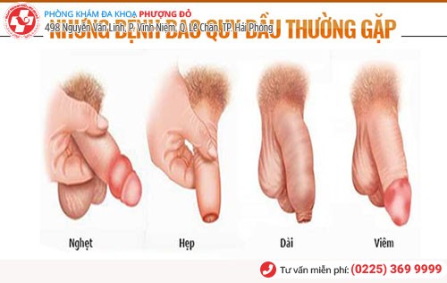 Tổng quan bệnh bao quy đầu