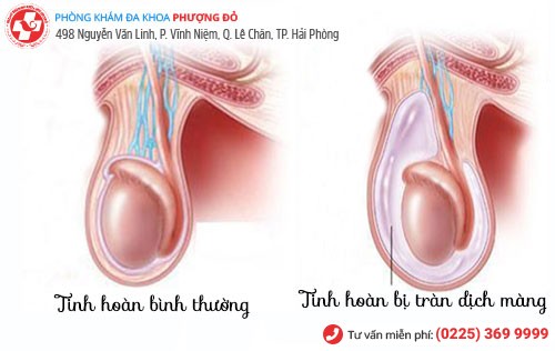 biểu hiện tràn dịch màng tinh hoàn