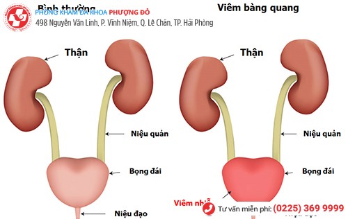 Cần gấp cho những ai chưa biết về viêm bàng quang