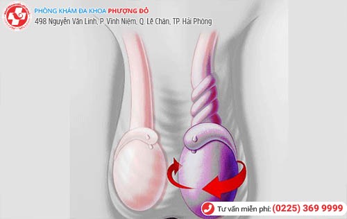 Xoắn Tinh Hoàn Cẩn Thận Kẻo Mất Bi