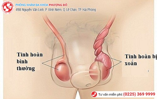 Xoắn tinh hoàn - chậm là “chết”