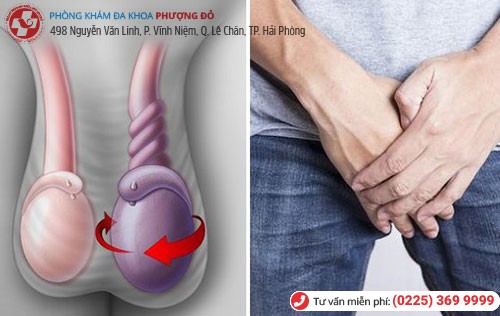 Siêu âm tinh hoàn giúp phát hiện xoắn tinh hoàn