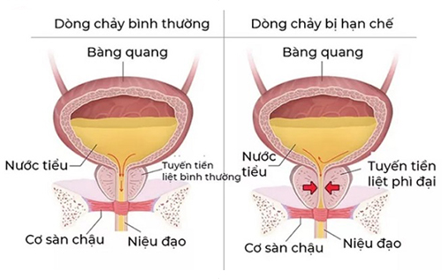 Bí tiểu – Nguyên nhân, biến chứng và cách điều trị hiệu quả.