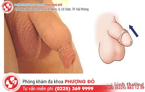 Thừa bao quy đầu ở nam giới nên làm gì?