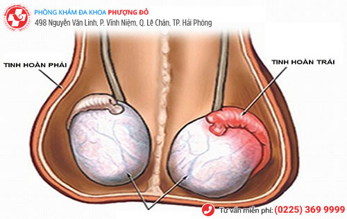 Vô sinh vì viêm mào tinh hoàn – chớ nên chủ quan