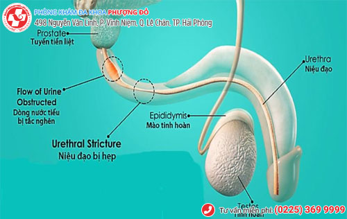 Hẹp lỗ tiểu do bẩm sinh