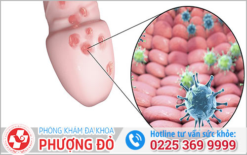 Nổi mụn ở dương vật do nguyên nhân gì và cách chữa trị hiệu quả