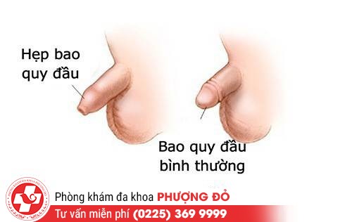 Hình ảnh hẹp bao quy đầu ở người lớn