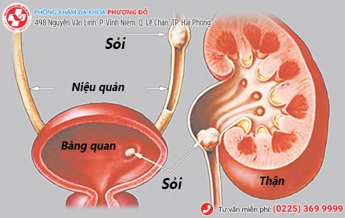 Vì sao bị viêm đường tiểu? Dấu hiệu và cách điều trị