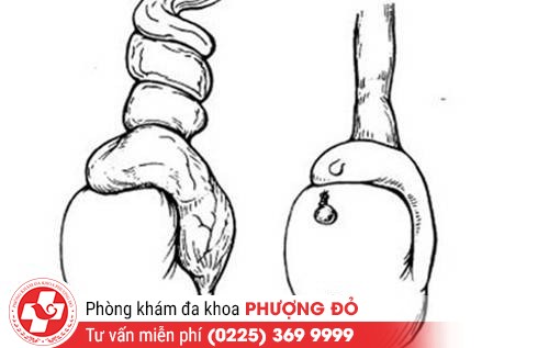 Cảnh giác cao với xoắn tinh hoàn